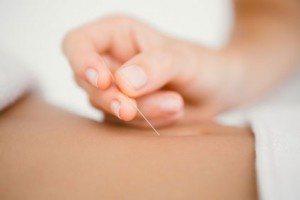 Acupuncture-for-Migraines