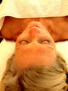 Facial/Cosmetic Acupuncture W6