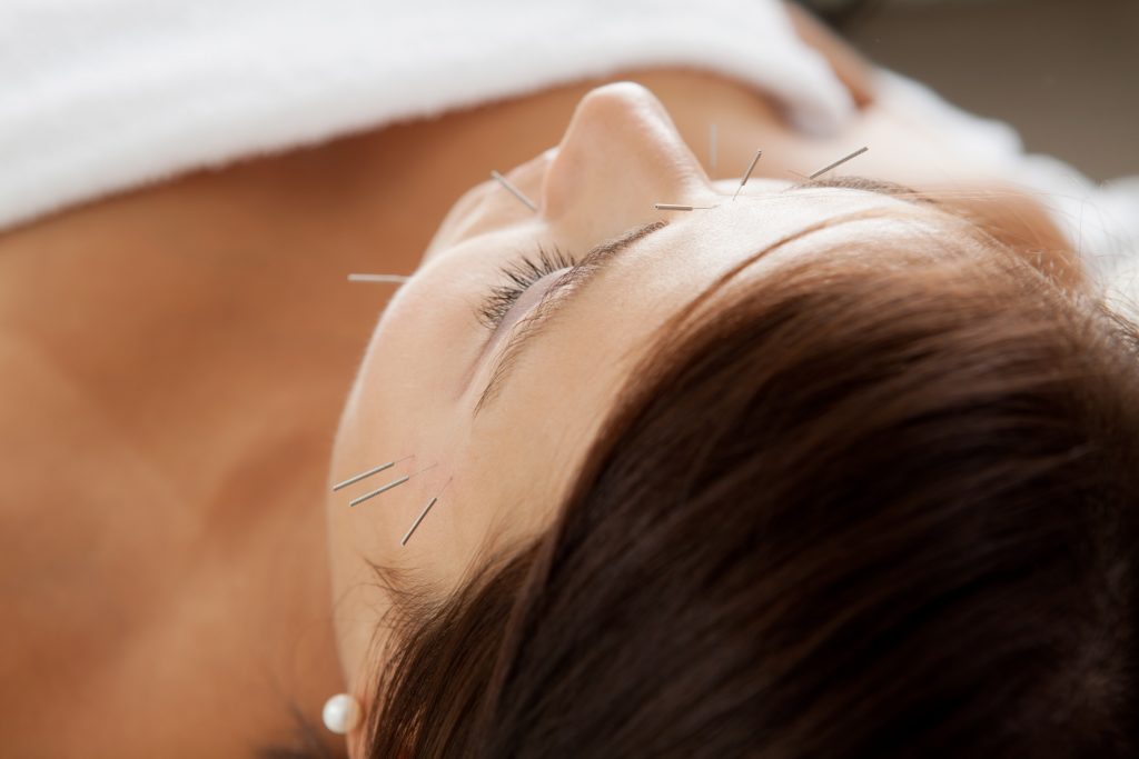 Facial Acupuncture Hammersmith West London Cosmetic Acupuncture W4